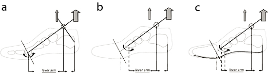 Figure 2 from Partial foot amputations in the combat wounded.