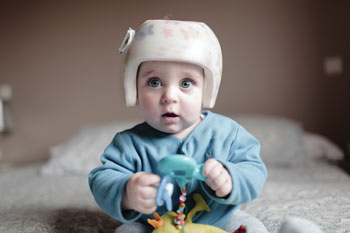 infant in cranial remolding orthosis