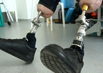 a man with bone-implanted leg prostheses. osteointegration