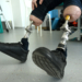 a man with bone-implanted leg prostheses. osteointegration
